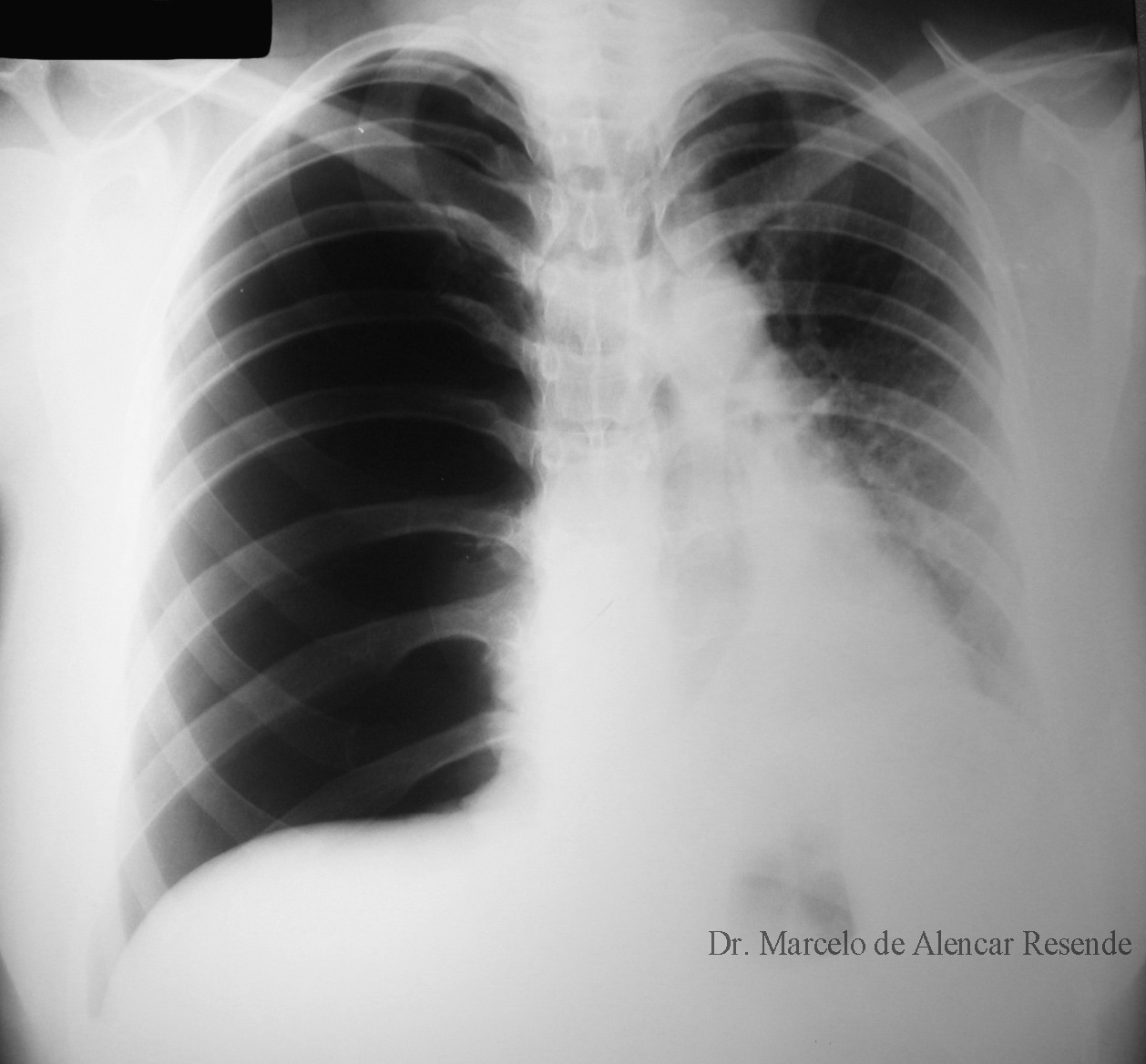 pneumot-rax-marcelo-de-alencar-resende-cirurgia-tor-cica